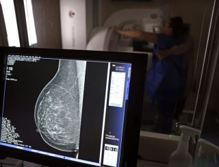 Entidades médicas pedem faixa etária maior para mamografia de rastreio